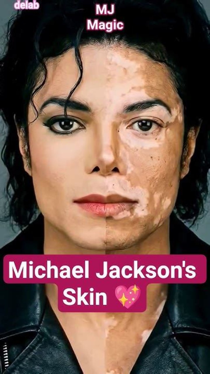 Michael Jackson&rsquo;s Skin Condition